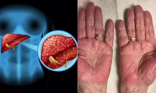 Liver Disease Warning Signs: Changes in Your Hands That May Indicate Liver Problems