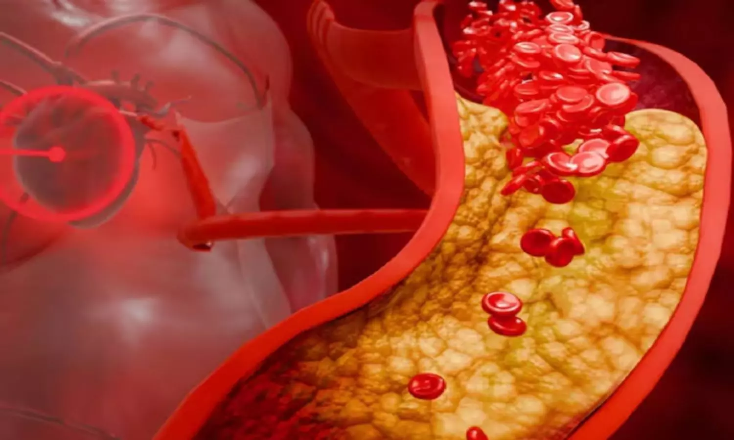 Evolocumab for Heart Health