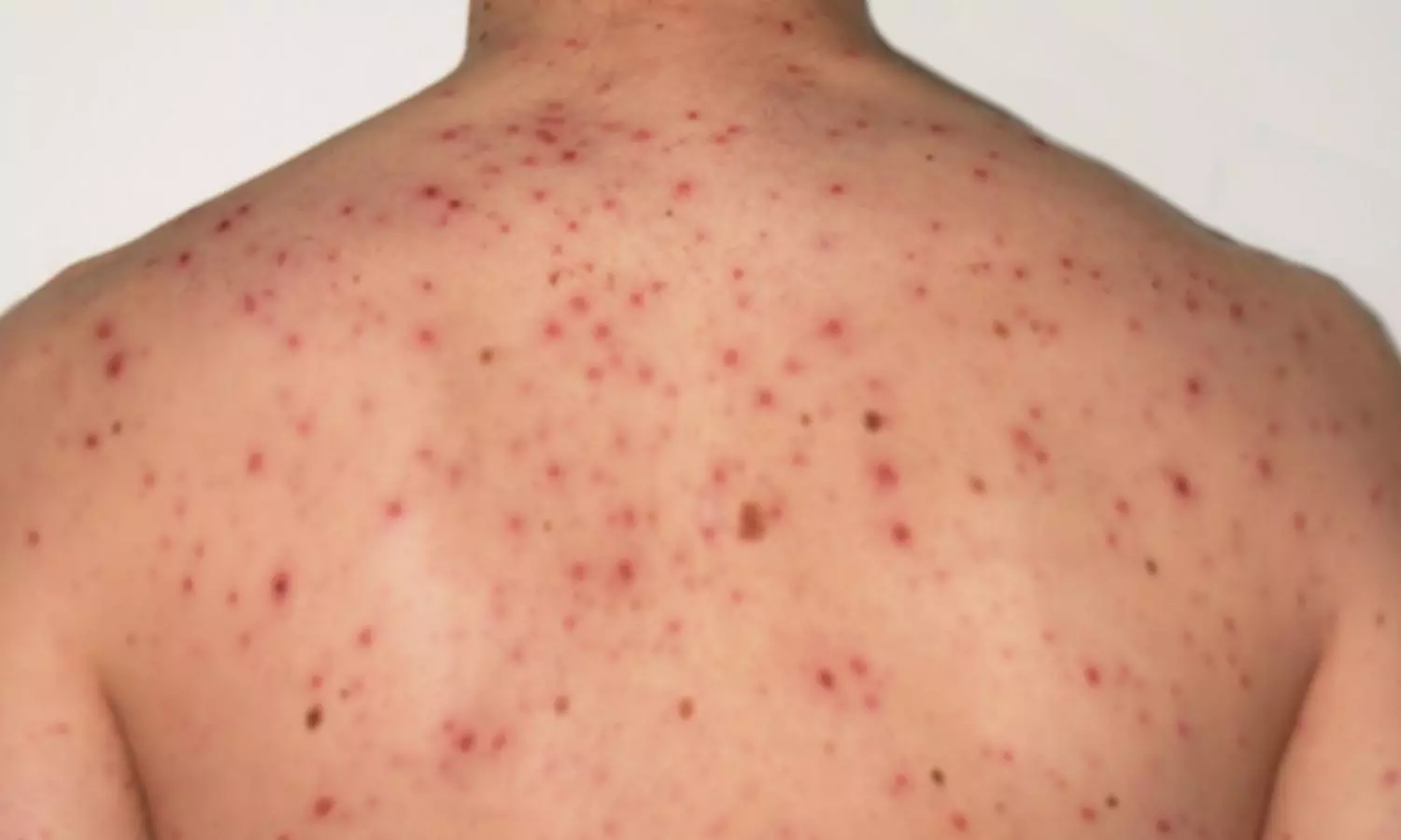Chickenpox Symptoms, Causes and Treatment Tips in Telugu