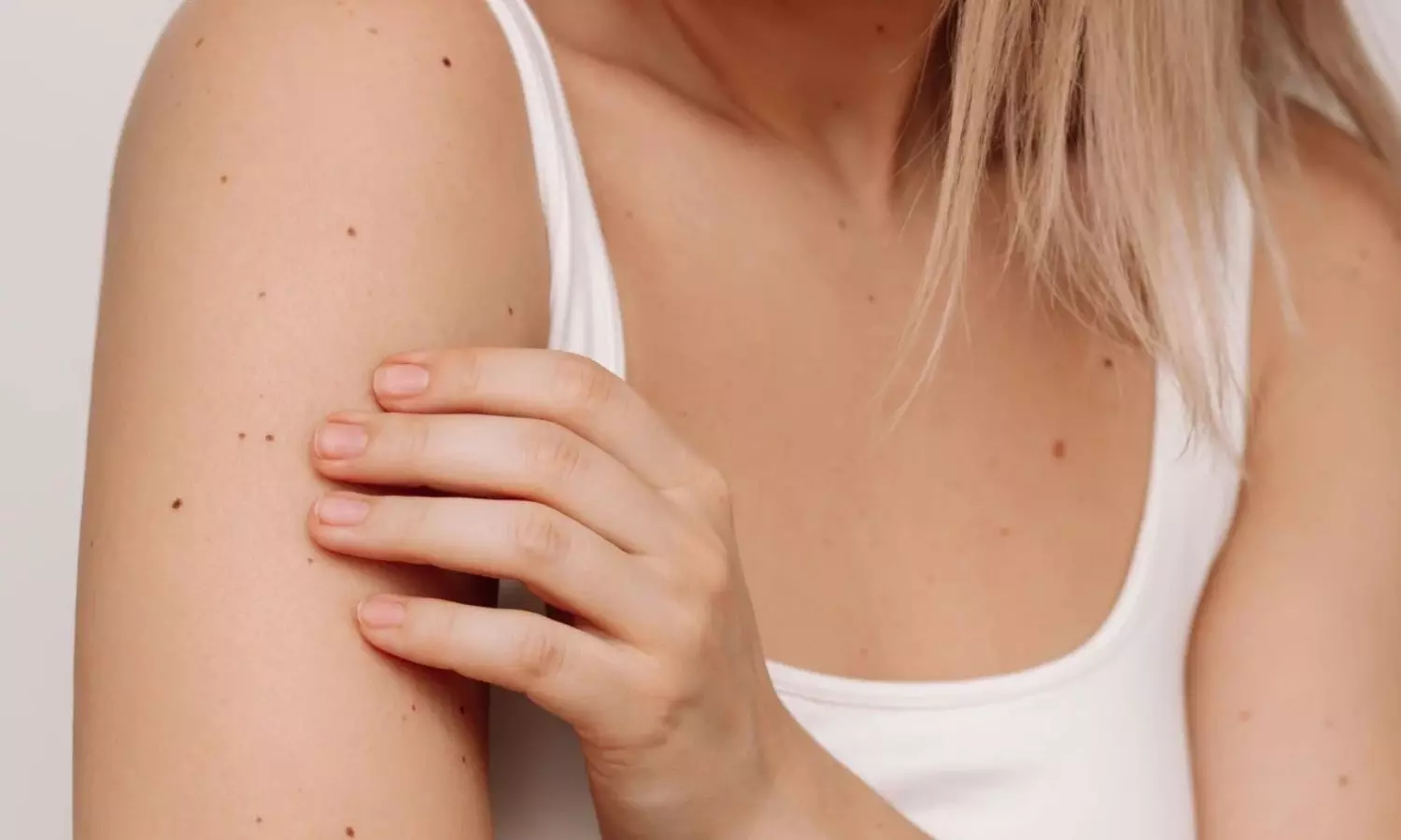 Moles on Body