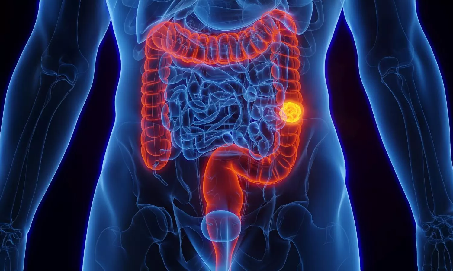 Colon Cancer
