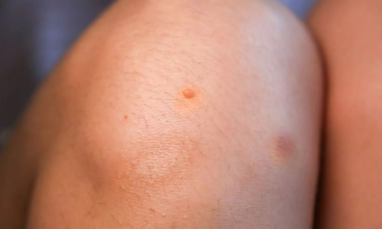 Mole on Knee Meaning: లక్కంటే వీళ్లదే... దేశాలు తిరిగిరావడానికి ఈ మచ్చే కారణం Mole on Knee Meaning: లక్కంటే వీళ్లదే... దేశాలు తిరిగిరావడానికి ఈ మచ్చే కారణం