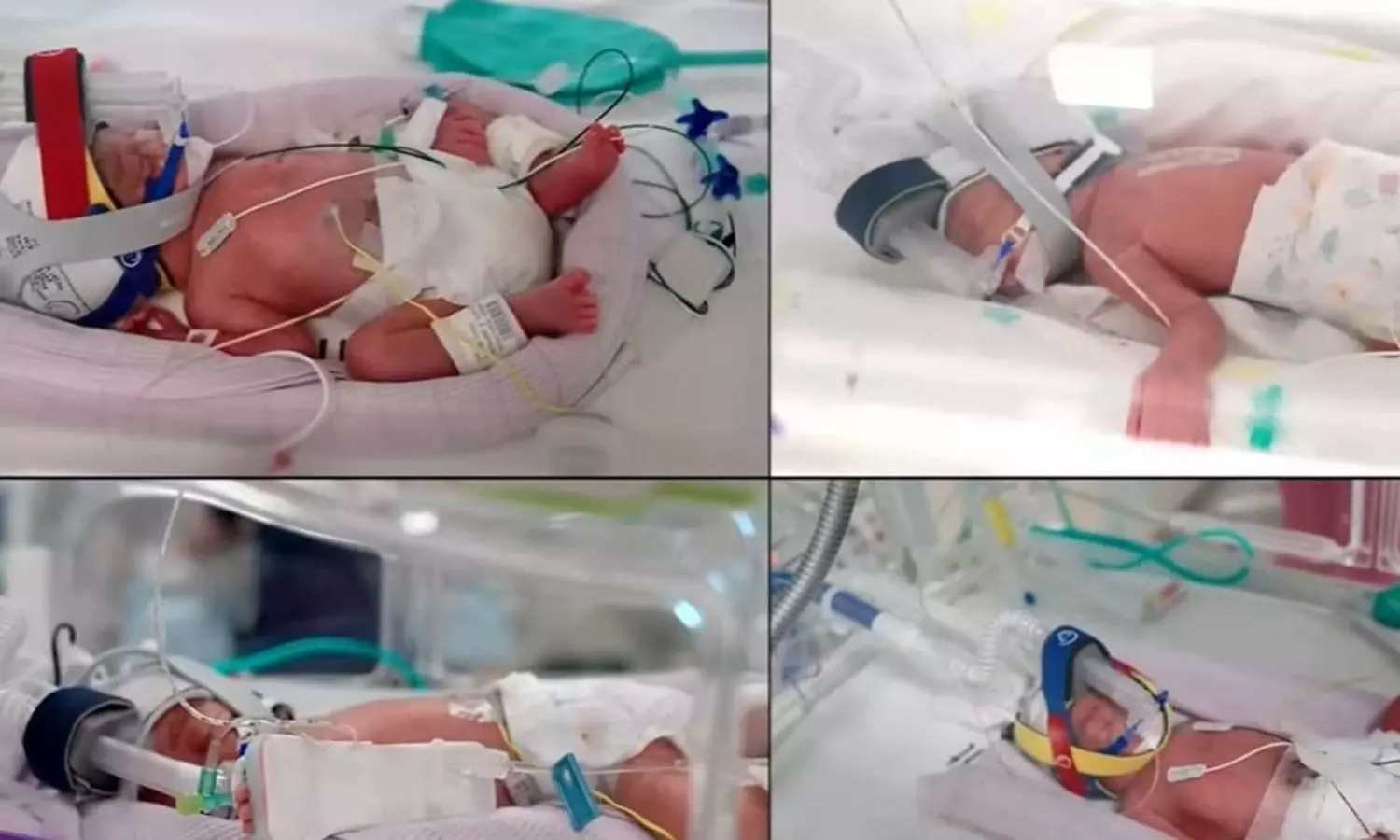 Identical Quadruplets: వైద్య చరిత్రలో అద్భుతం... ఒకే అండం నుంచి నలుగురు ట్విన్స్ జననం Identical Quadruplets: వైద్య చరిత్రలో అద్భుతం... ఒకే అండం నుంచి నలుగురు ట్విన్స్ జననం