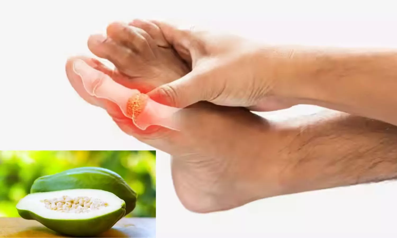 Uric Acid Home Remedy Uric Acid Home Remedy