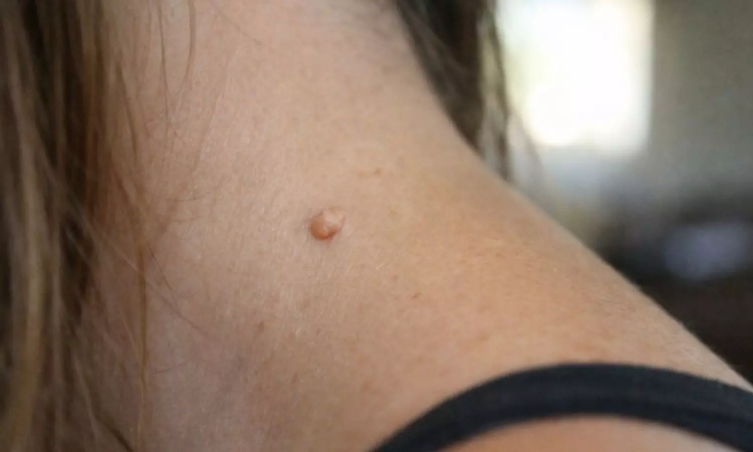 Warts Removal Tips Warts Removal Tips