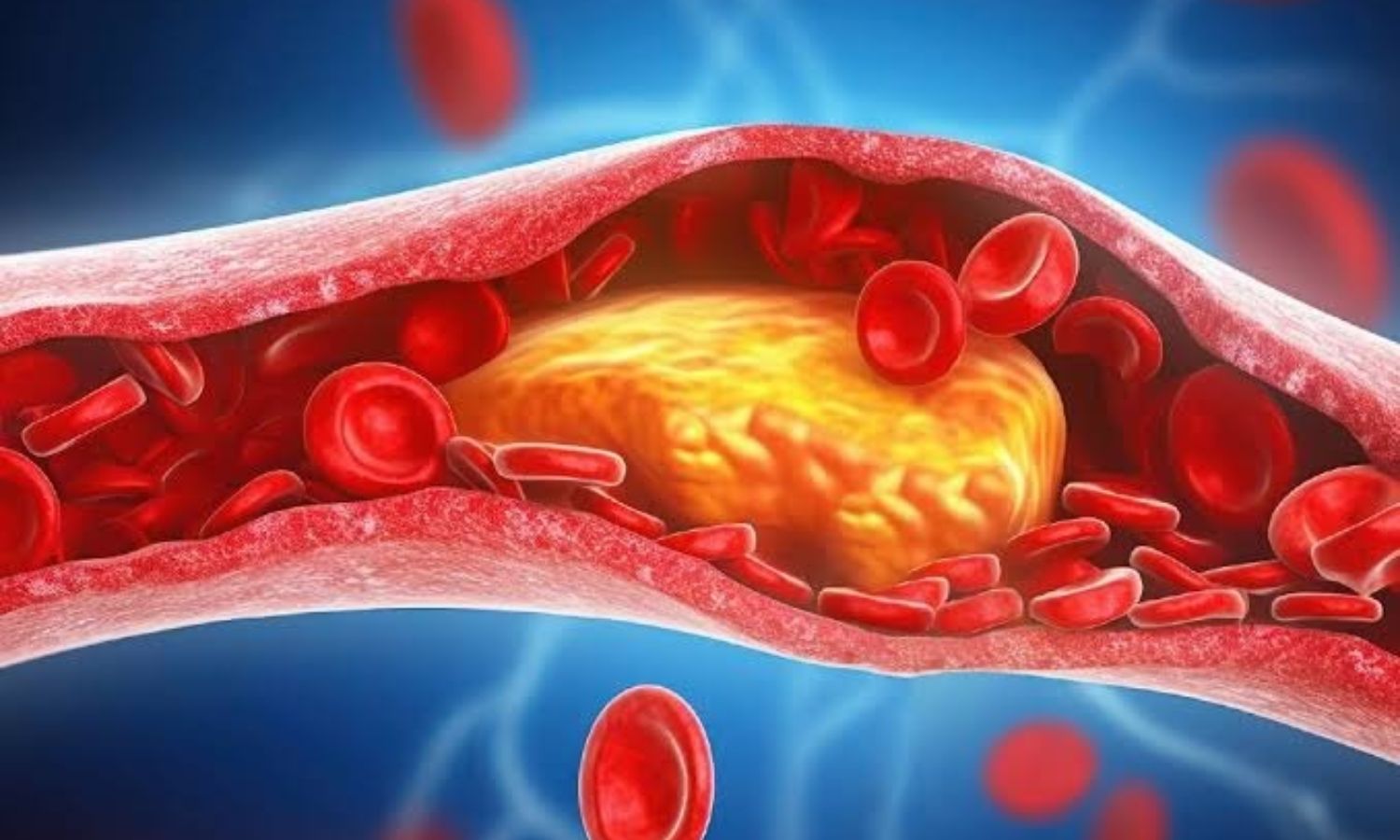 కొలెస్ట్రాల్ నియంత్రణకు జీవనశైలి మార్పులు