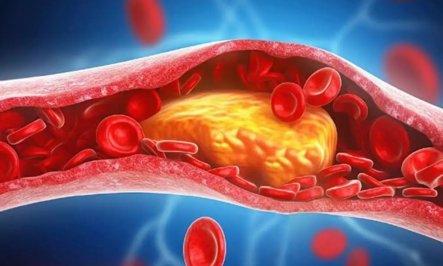 cholesterol