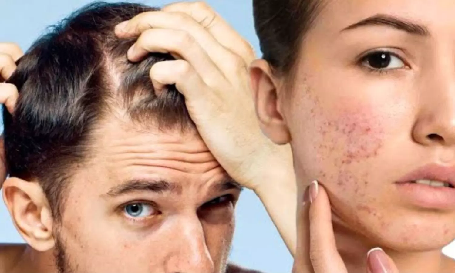 Zinc deficiency Zinc deficiency