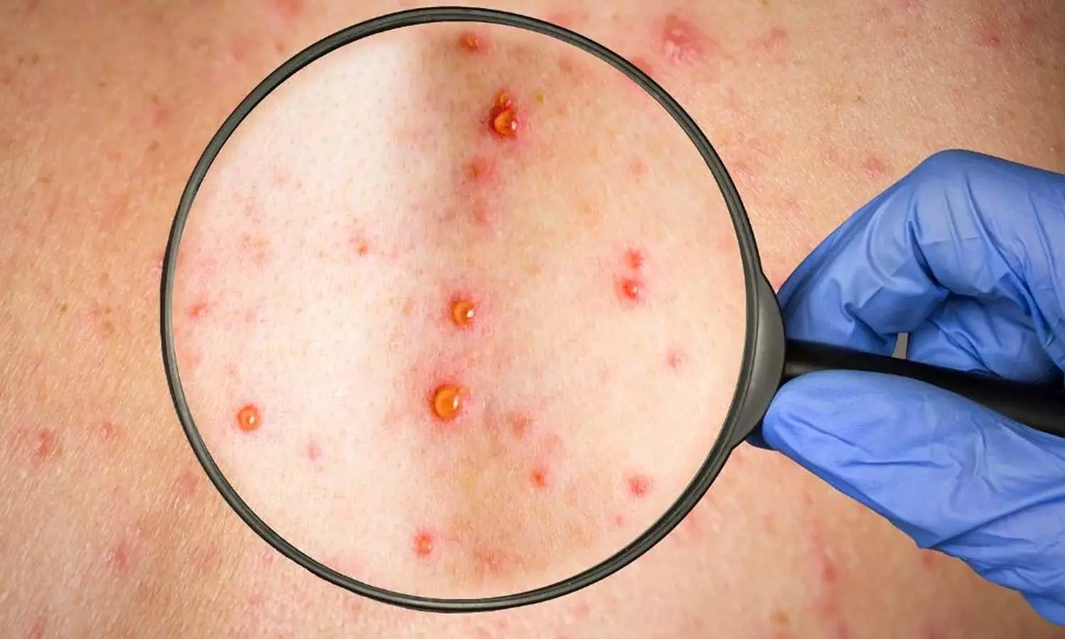 Rubella Virus