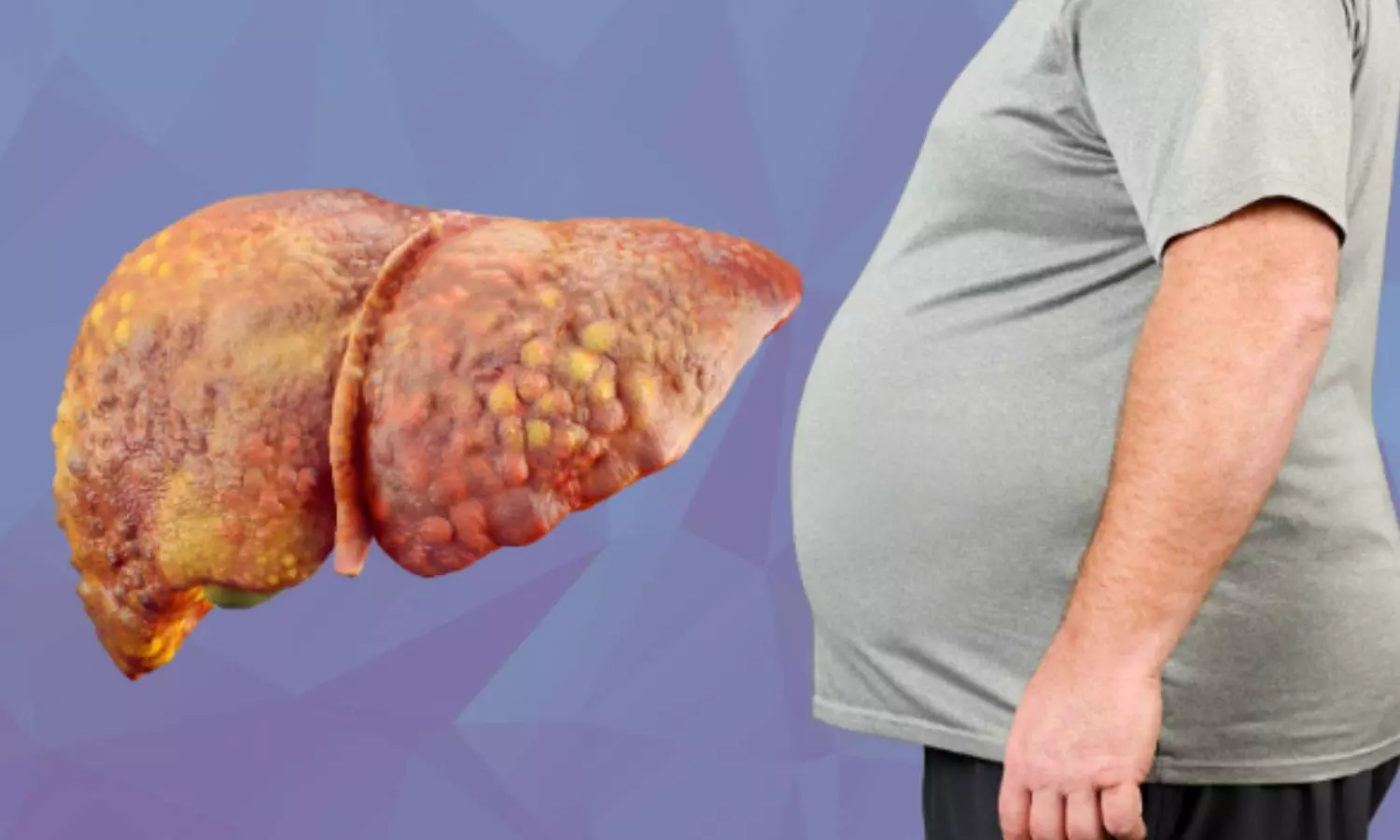 Fatty Liver Fatty Liver