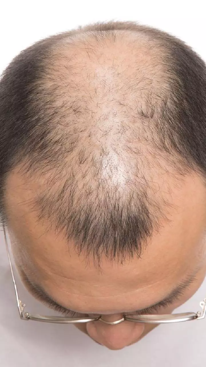 Hair Loss: జుట్టు రాలే సమస్యకు పోషకాహార లోపమే కారణమా? ఈ తప్పులు అస్సలు చేయకండి