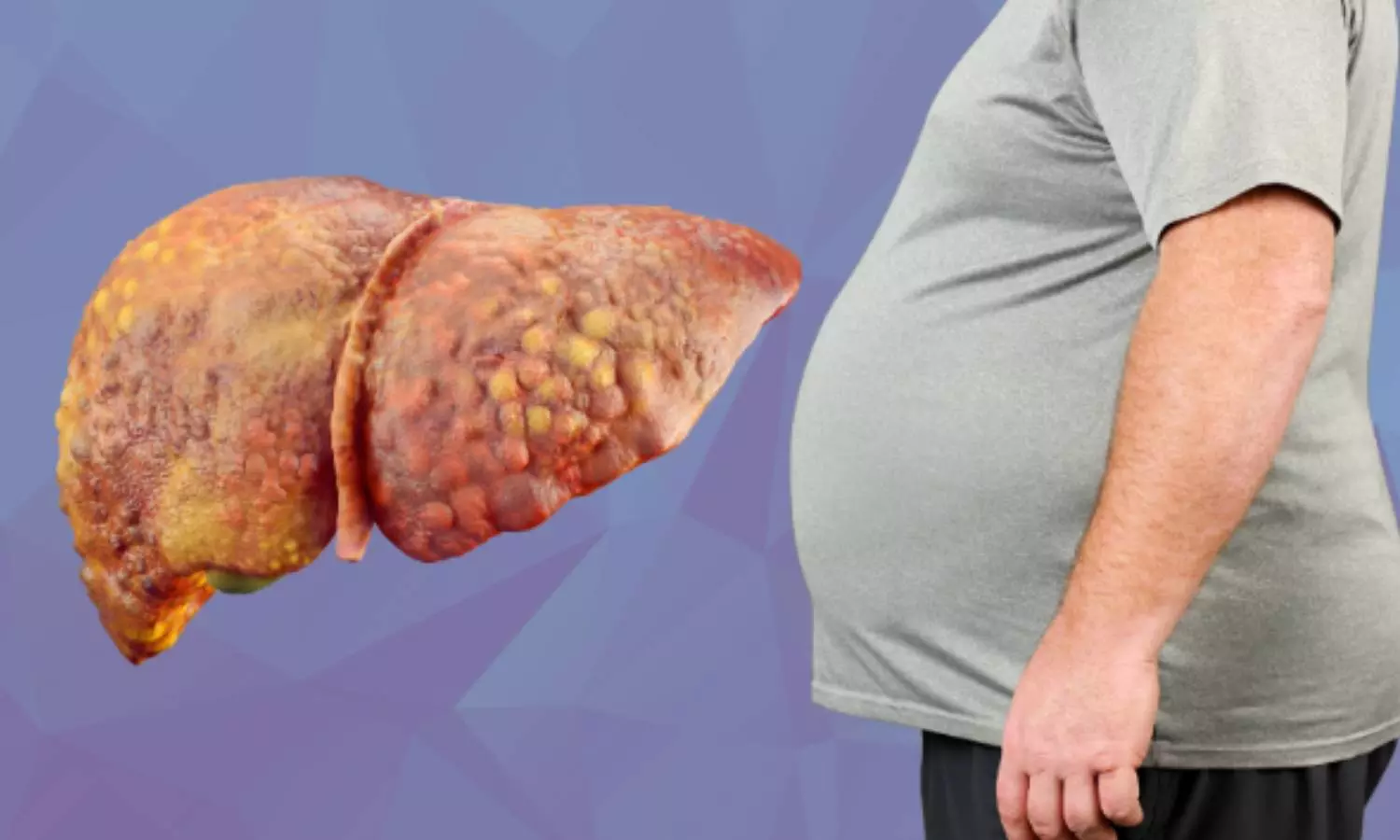 Fatty Liver