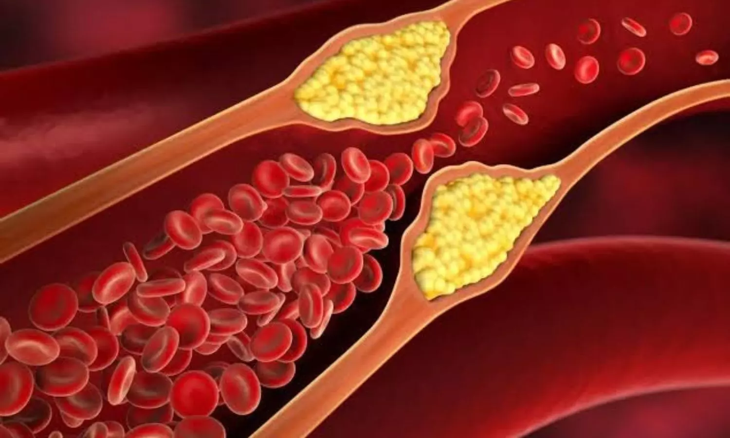 High cholesterol High cholesterol